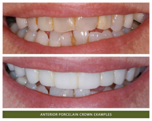 A Boulder County Smiles patient before and after porcelain dental crowns.