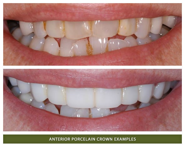 Dental crowns patient in Boulder before and after photos