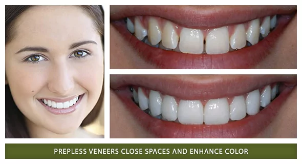 Boulder prepless veneers for teeth patient photos