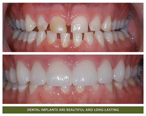 Before and after implants
