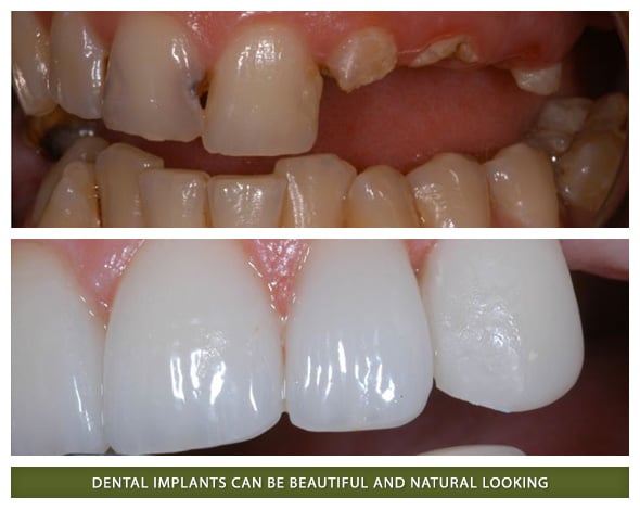 Before and after dental implants