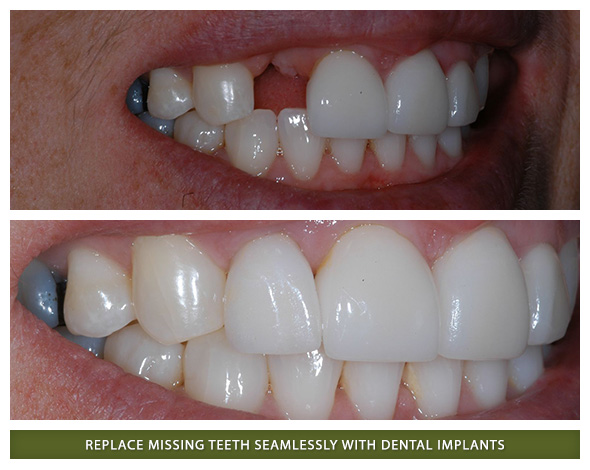 Before and after single dental implant