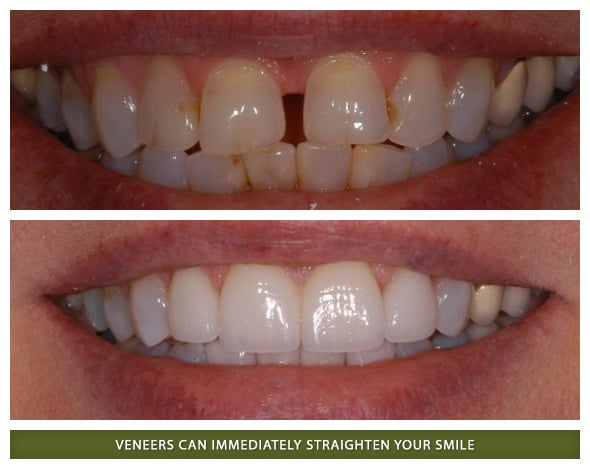 Before and after dental veneers