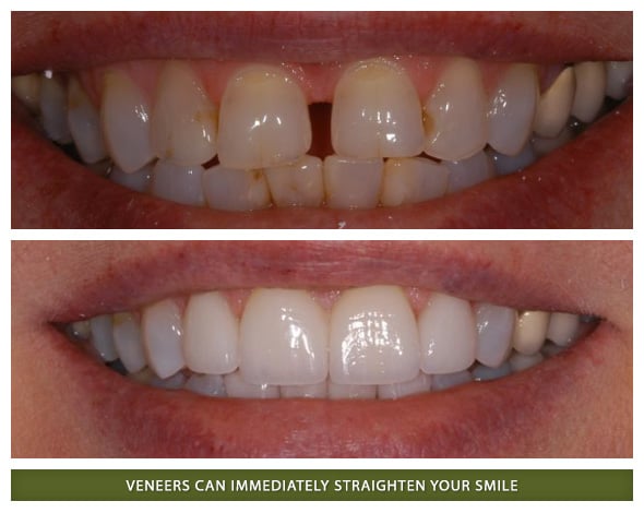 Instnat orthodontics in Boulder and Lafayette with dental veneers before and after photos