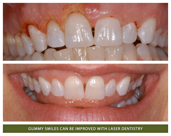 Laser dentistry and gum reshaping patient in Boulder