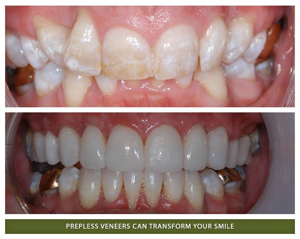 PreplessVeneers2