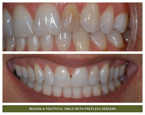 PreplessVeneers3