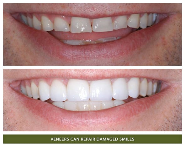 Veneers1