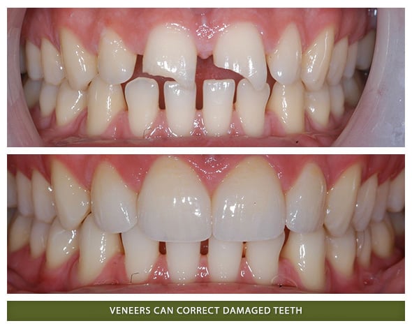 Veneers1