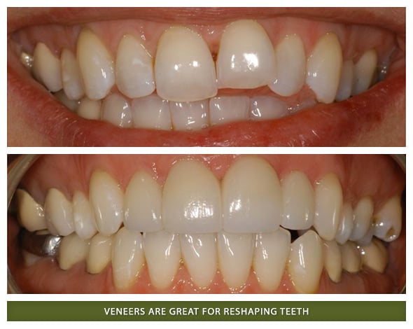 Veneers2