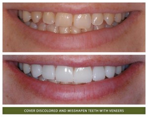 Dental veneers patient in Boulder bright white straight smile