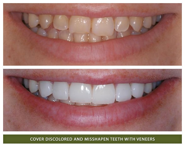 Veneers3