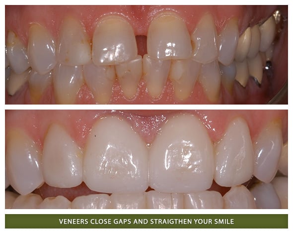 Veneers3