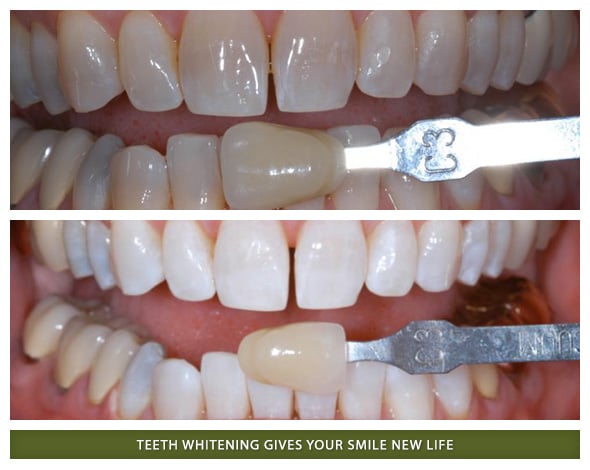 Whitening1