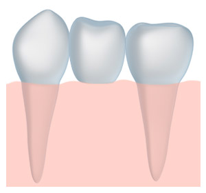 dental bridge for missing teeth Boulder dentist Lafayette, CO