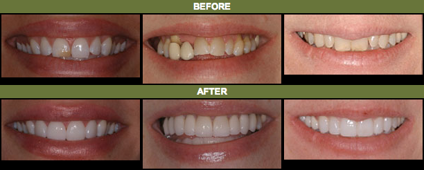 Before and after photos of cosmetic dentistry patients of Lafayette, CO cosmetic dentist Dr. Gordon West