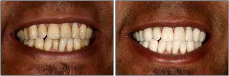 tooth bleeching