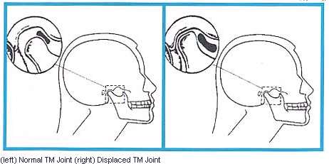 TMJ treatment for headaches in Boulder and Lafayette, CO