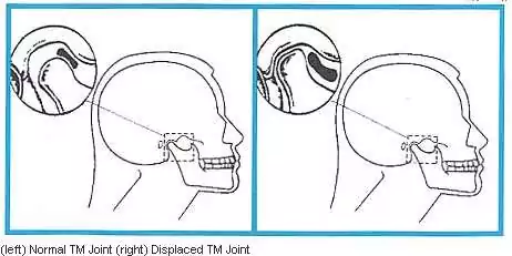 TMJ Illustration