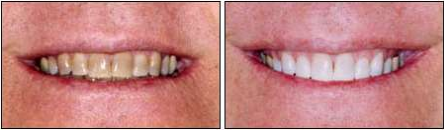 Opalescence take-home teeth whitening