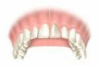 Before the tooth crown procedure - Boulder dentist Dr. Gordon West