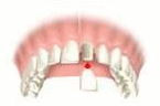 Placing the new dental crown - Dr. West in Boulder