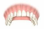 Porcelain crowns placed by Dr. West, a dentist in Lafayette, CO