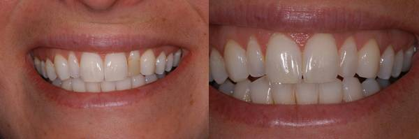 Porcelain veneers illustration