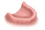 full arch replacement implants Boulder