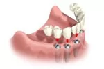 implant supported dentures Boulder