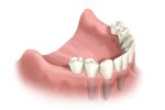 alternative dentures Lafayette, CO dentist Longmont