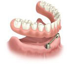 dental implants dentist in Boulder