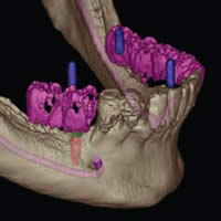 dental implants surgery in Boulder and Lafayette, CO