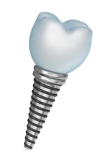 dental implant dentistry Boulder