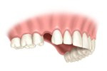 single tooth replacement in Boulder and Lafayette, CO