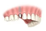implant dentures in Boulder and Lafayette, CO