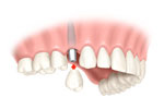 dental implants dentist Lafayette, CO
