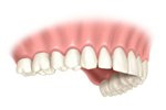 permanent dentures in Boulder and Lafayette, CO