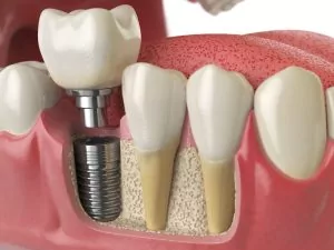 Dental Implant Single Tooth Replacement Lafayette CO - Boulder County Smiles