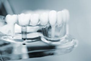 Multiple Tooth Dental Implants Lafayette CO - Boulder County Smiles