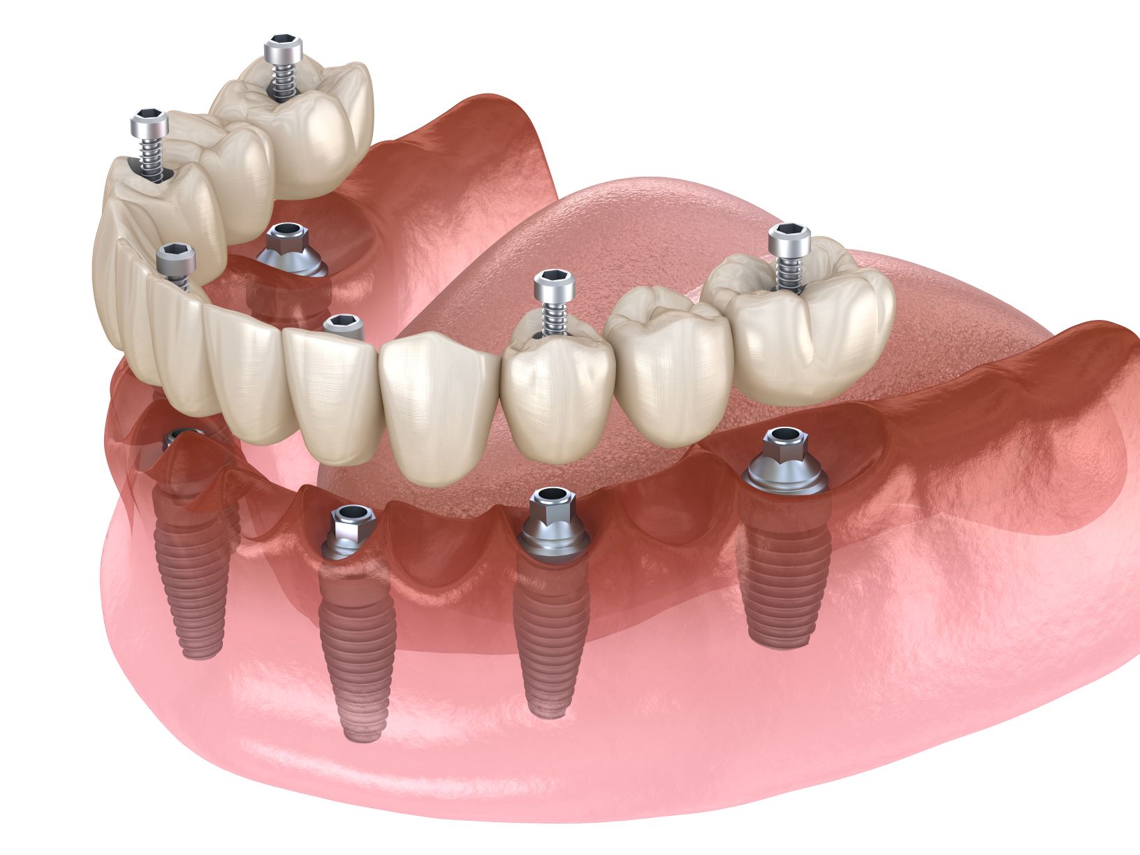 Full Arch Denture Implants Lafayette CO - Boulder County Smiles