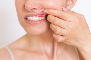 A close-up photo of a young Caucasian woman who shows off her red gums on the upper jaw, suffers from gum inflammation.