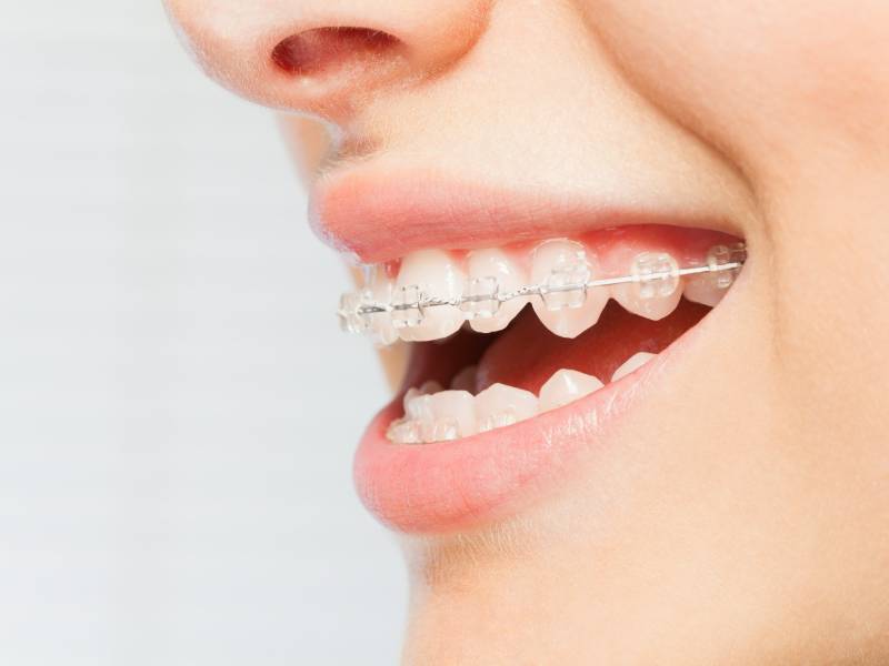 Invisible braces closeup