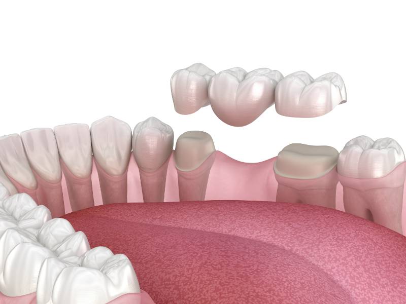 Dental bridge
