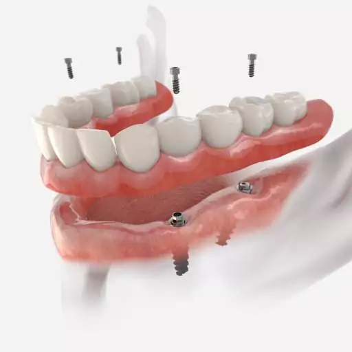 Fixed Dentures