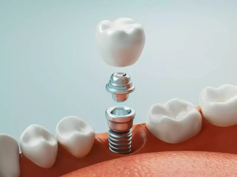 Dental implant