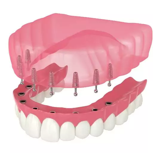 Snap on Dentures