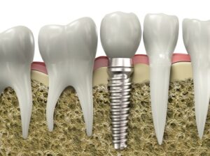 Graphic image of a dental implant embedded in a jawbone.