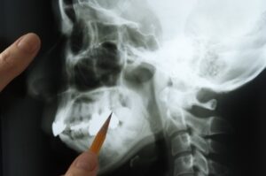 A jawbone being examined in an emergency dental treatment visit in Boulder.